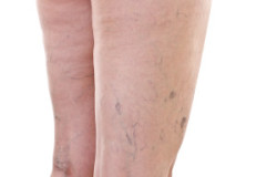 Legs With Varicose Veins