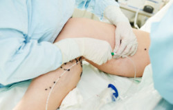 surgeon performs varicose veins correction operation on a patien