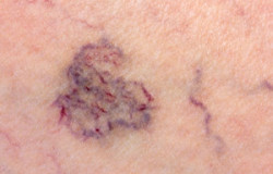 Close-up Of Skin With Varicose Veins