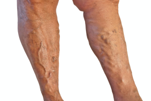 Varicose Veins